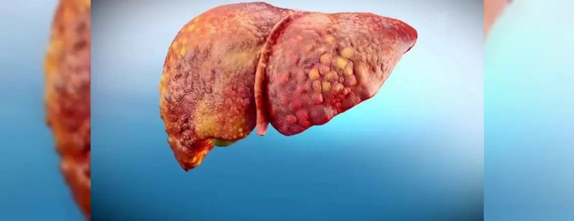 Kronik Karaciğer Hastalığı