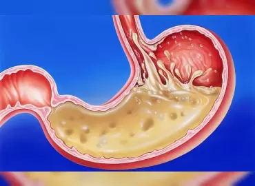 mide-barsak-hastaliklari-ve-kolon-kanseri