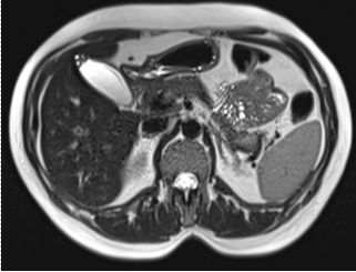 safra-kesesi-adenomiyomatozisi