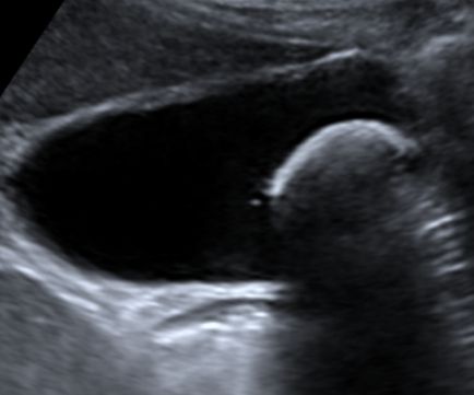 safra-kesesi-varyasyonlari-ve-sekil-bozukluklari